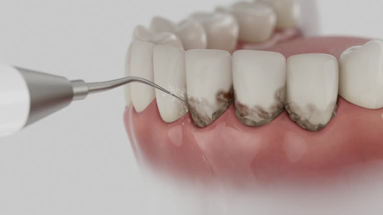 Reliable Tooth Extraction contractor in Commerce, TX by Smile Center Dentistry